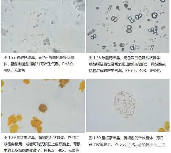 高清图谱尿液结晶形态汇总