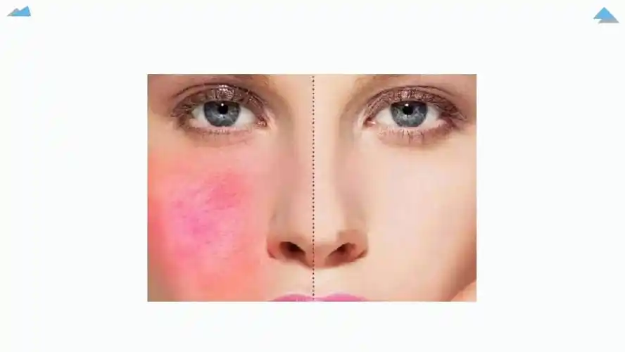 中美杜克护肤:敏感性红血丝皮肤怎么改善.ppt