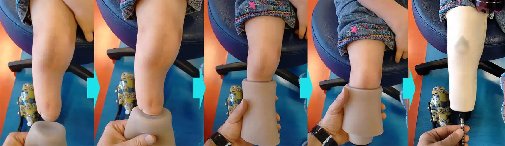 假肢硅胶套对伤残口皮肤有哪些好处?