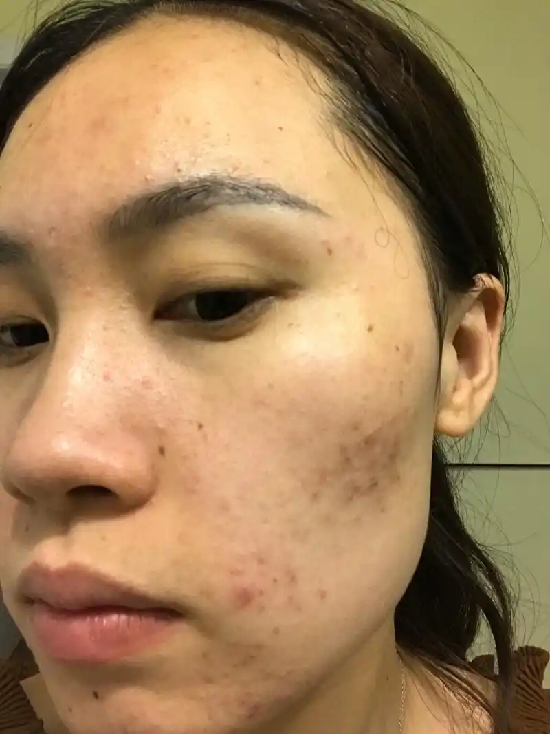 记录自己好几年的痘痘肌 皮肤状态太差了.