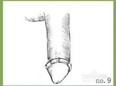 9  包扎 将一条凡士林纱布(毛边叠在内里)围绕包皮隐语处,用留长的