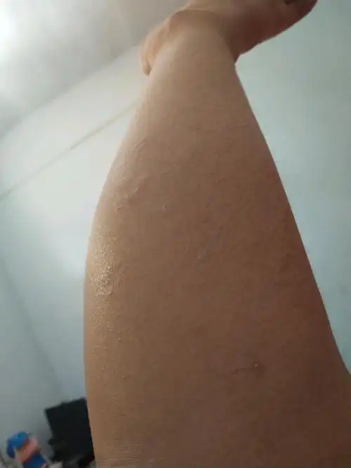 怀孕到现在腿上长了好多癣,痒得难受,不敢用药!