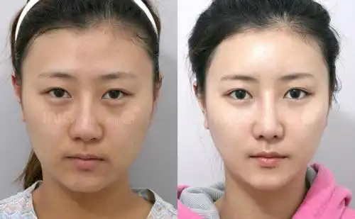 ing整形外科面部脂肪填充日记对比