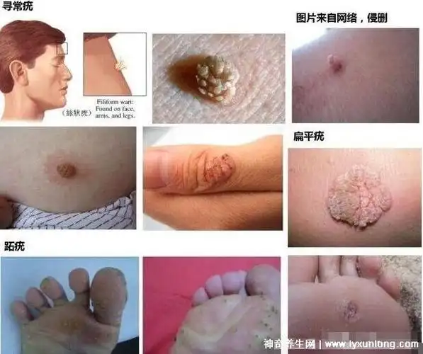 hpv是什么病毒图片感染女性hpv真实图片警惕寻常疣宫颈癌