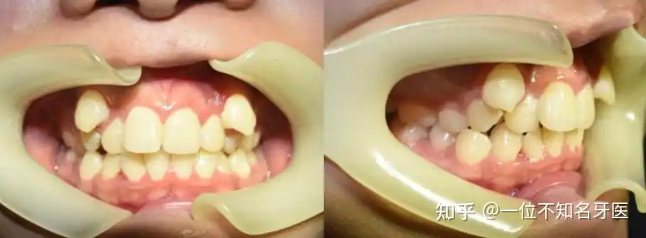 虎牙可以磨平吗为什么会有虎牙虎牙能拔吗