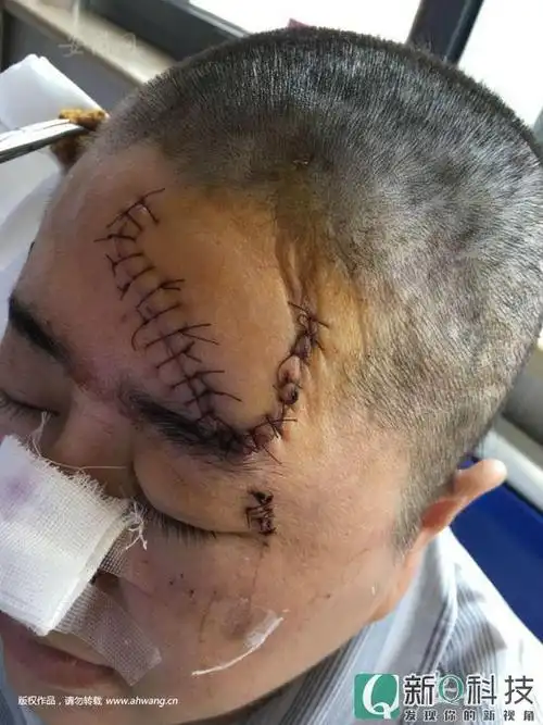 女子劝解夫妻吵架被对方丈夫砍伤 全身缝了106针