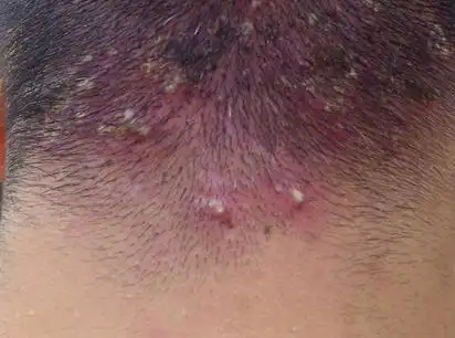 毛囊炎 - 宜宾好的白癜风医院_宜宾治疗白癜风医院哪家好_宜宾华肤