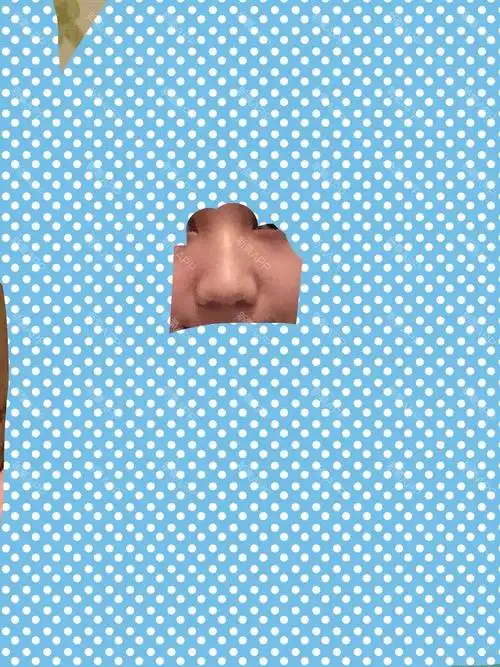 氧气568e27af3252093 | 术后当自强 | 新氧 | 切开鼻孔法鼻翼缩小