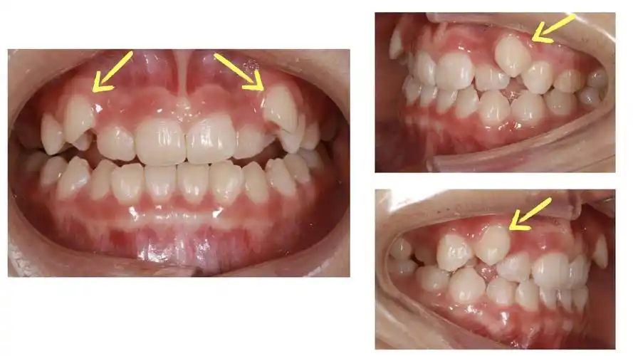 虎牙在哪里什么样的牙齿是虎牙