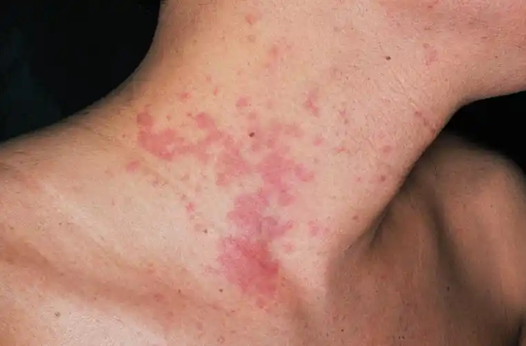 螨虫咬的小红点图片