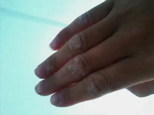 手指节上起皮,怎么了?医生看看吧!跪求!