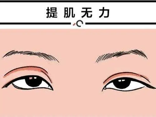 一般来说,判断上眼睑肌无力的方法,主要就是要看上眼_圈子-新氧美容