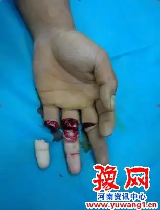 不小心剁断手指 妙手仁心接起来