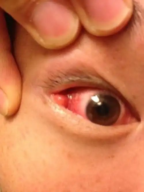 急性的传染性的结膜炎临床的表现的图片_有来医生