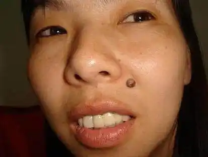 解析女人脸上几处克夫痣,最好点去