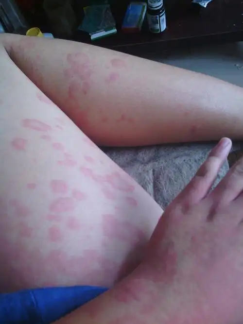 我前几天用了一种护发素然后过敏了身上长了一片一片的红疙瘩