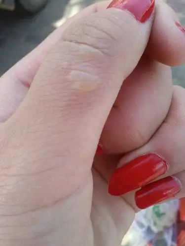 做饭时不小心手被锅里的蒸气灼伤,到现在为止变成水包了,好难受,有没