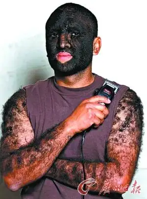 多毛症男如"狼人"称曾交35名女友 两周一理毛