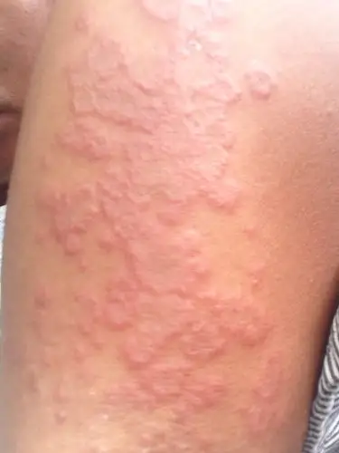 4 2010-01-03 高蛋白过敏症状 107 2012-04-08 高蛋白过敏 1 2009022