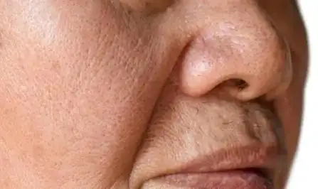 肌肤老化有哪些表现一般是哪种形态做医美又有哪些选择