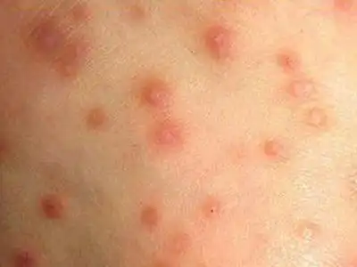 疥疮的初期症状图片 (5)