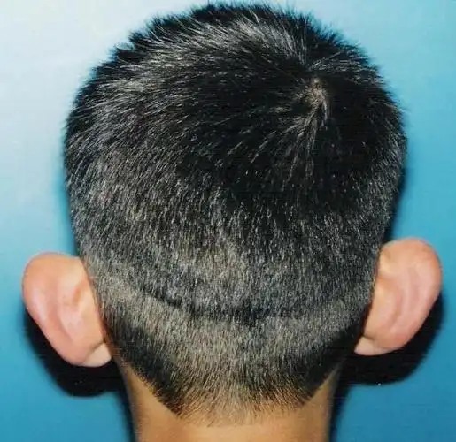 常见先天性耳廓畸形