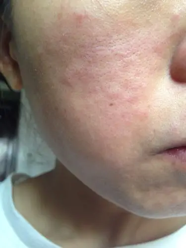 这样的皮肤毛孔堵塞怎么办