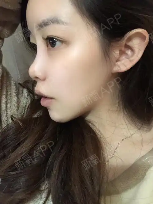 特别不喜欢自己的小肉鼻,还塌,侧面看可以说是没鼻子_圈子-新氧美容