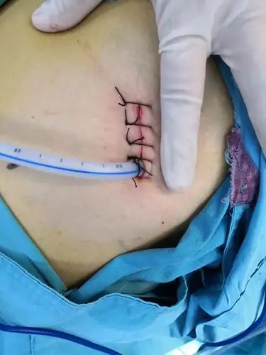 胸腔镜单切口切除右肺下叶肿物