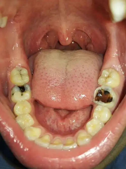 16周岁 第二磨牙松动 痛 要不要拔 镶牙可以吗 价格怎么样