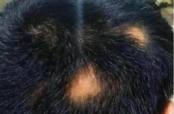 身体缺什么会大把掉头发原因告诉您秀发自己长出来