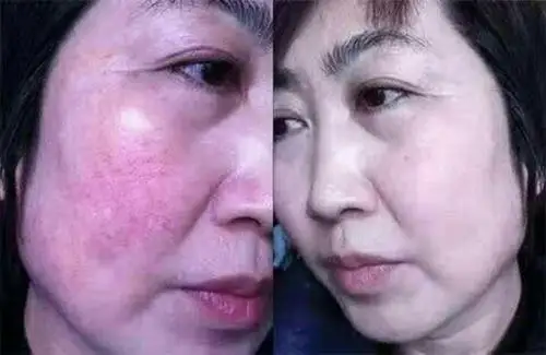 这是红血丝肌肤,用慕兰婷后的对比图