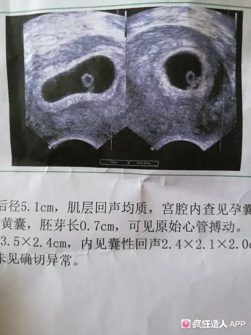 7w 0d, 能看到胎芽胎心了