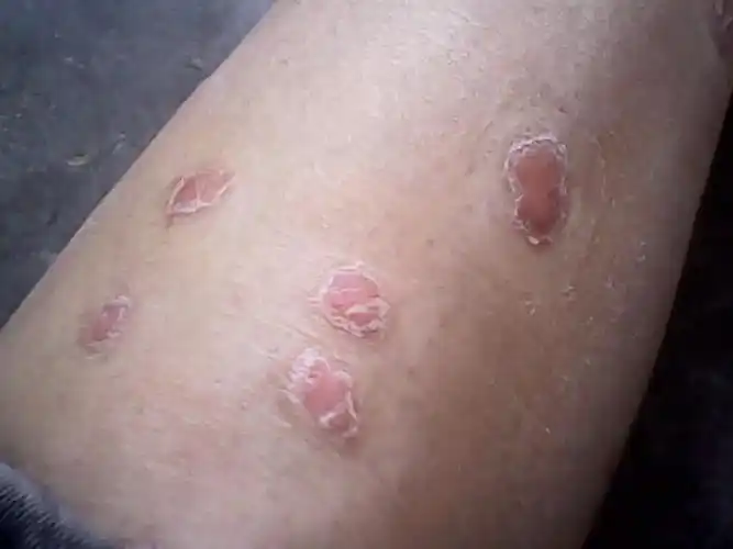 苹果绿 保健常识2,鳞屑脱落:如果出现牛皮癣引发瘙痒,不断的用手去抓