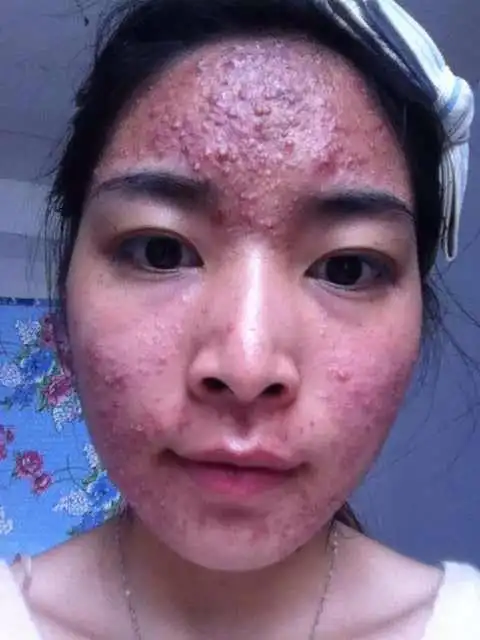 我想知道我脸上长的是痘痘还是什么?