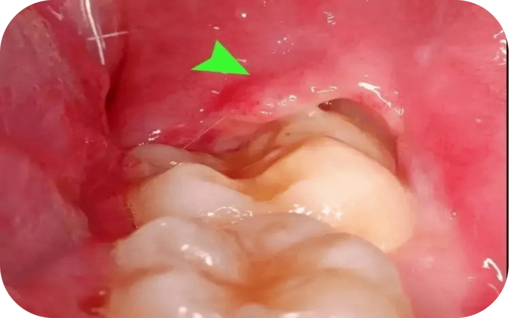 今天,小编要和大家讲的是智齿冠周炎,它是指智齿(第三磨牙)萌出不全或