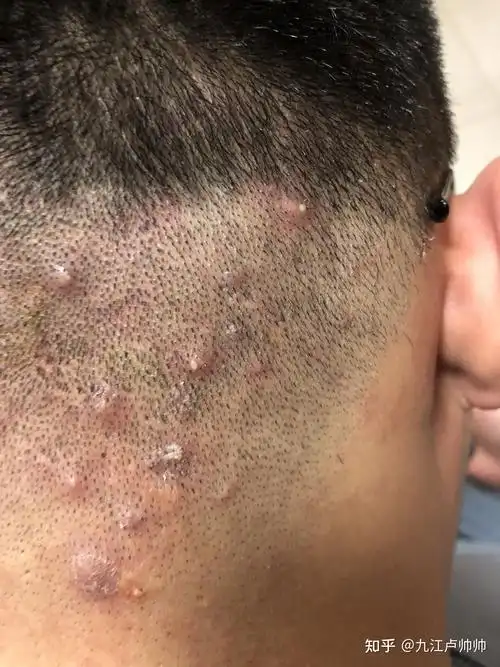 头皮毛囊炎的治疗之路