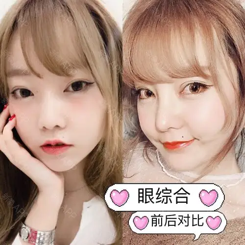 开外眼角和下至有副作用吗分享自己亲身经历