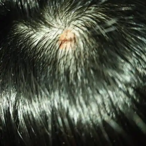 头皮上长了个东西