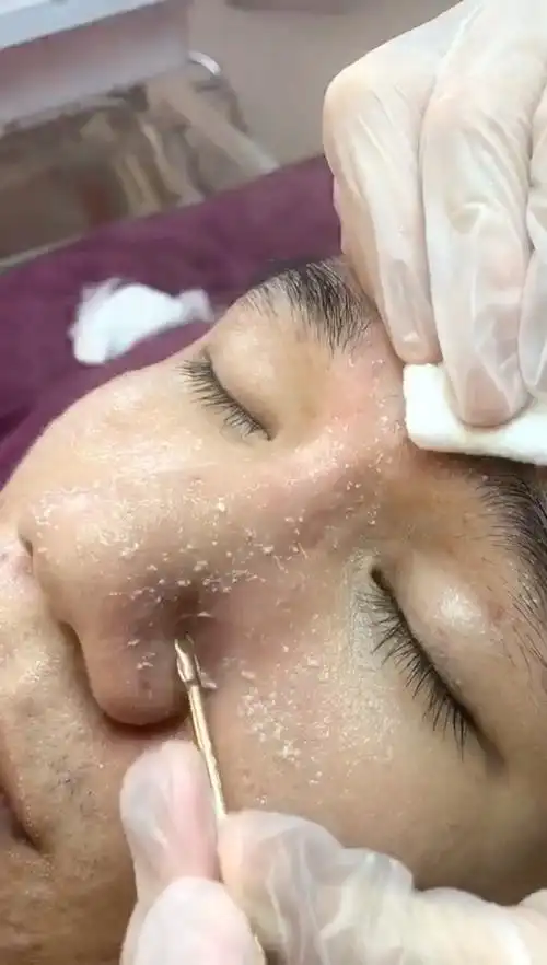 2020年最适合美容院拓客的毛囊清洁术