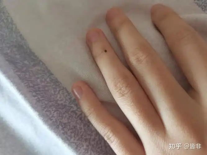 本人女左手无名指半年前多新长了一颗痣 有什么寓意? - 知乎