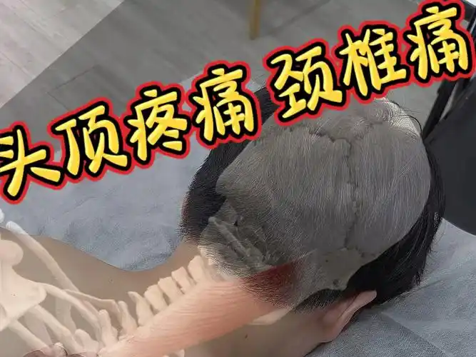 头顶疼痛 头皮紧 颈椎痛(头夹肌松解)