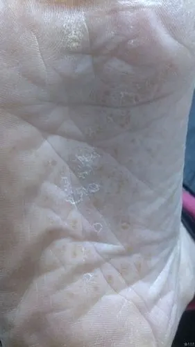 这个脚底怎么了?