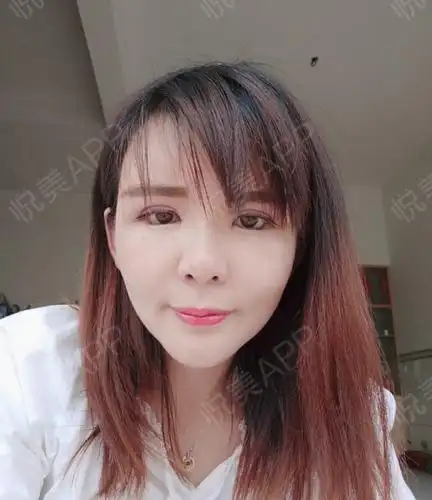 自体脂肪面部填充术后10天_面部填充术后10天_自体脂肪术后10天_面部