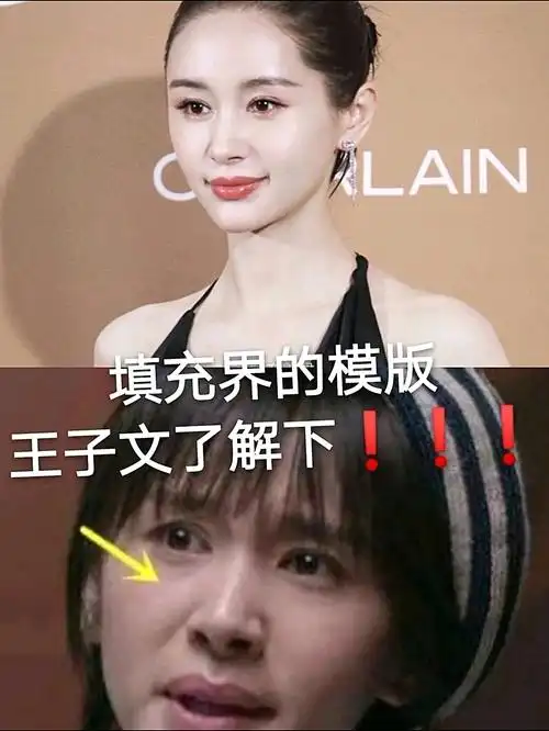 恰到好处的脂肪填充,王子文做的太绝了!