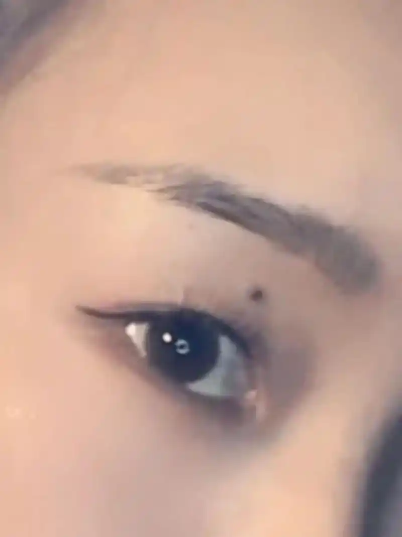 眼皮上长痣好吗 在犹豫要不要打掉 眼皮上长痣好吗 在犹豫要不要打掉