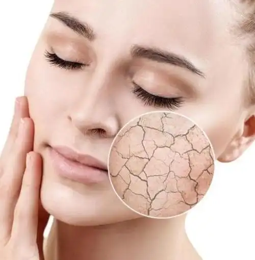 皮肤严重缺水会有刺痛感,但一般在秋冬季节.