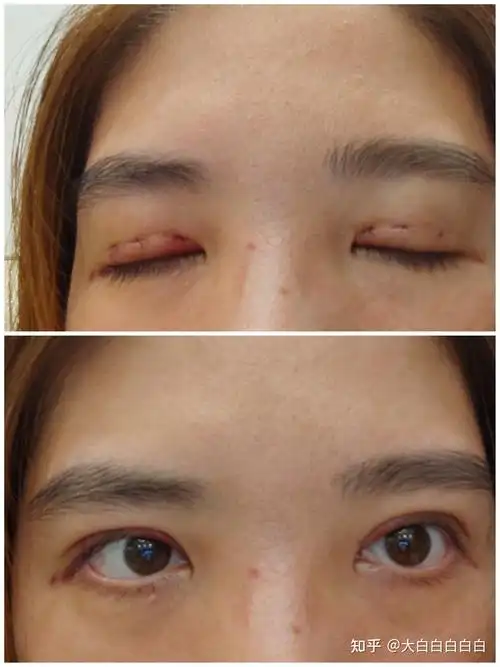 三点定位重睑术恢复过程记录