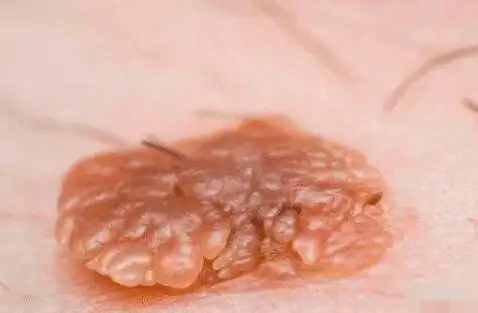 疣体的图片是什么样的-张磊-爱问医生