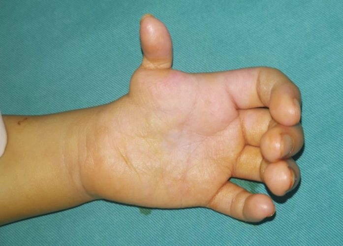 漂浮拇:成功保五指 | 案例1《半掌骨移植重建手术后,小男孩的漂浮拇指